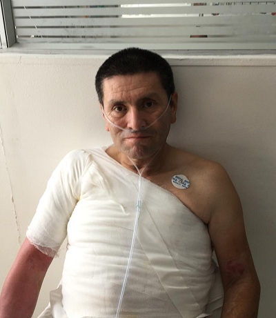 Tras varias intervenciones quirúrgicas, hombre se recupera de quemaduras por electricidad